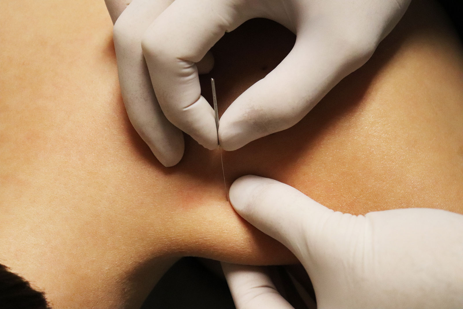 Our physiotherapist provides IMS treatment to increase the joint motion