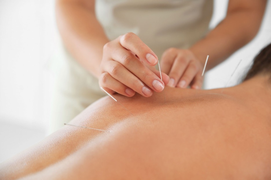 ACUPUNCTURE TREATMENT